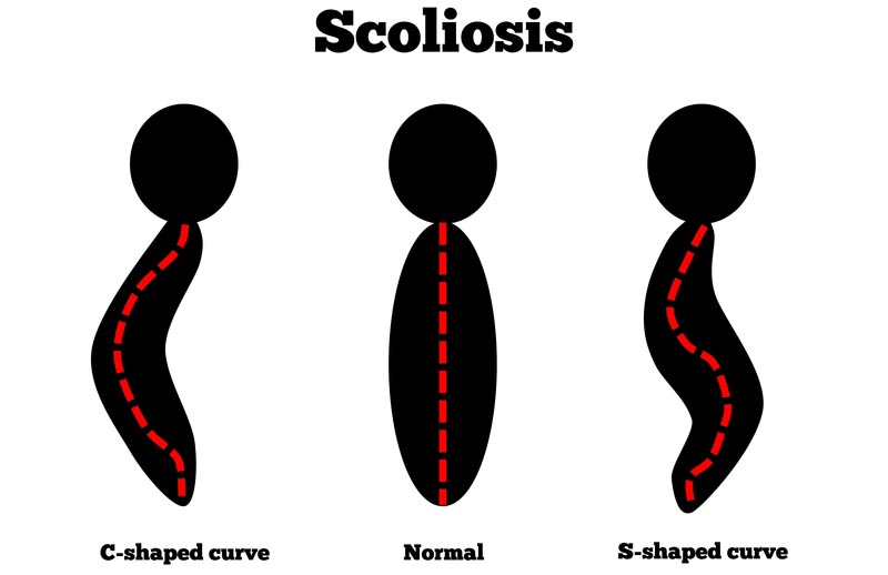 San Diego, CA scoliosis treatment